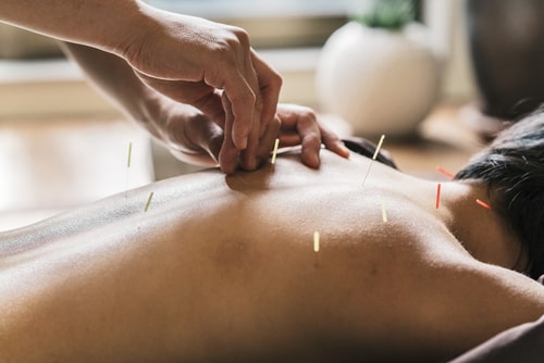 Acupuncture